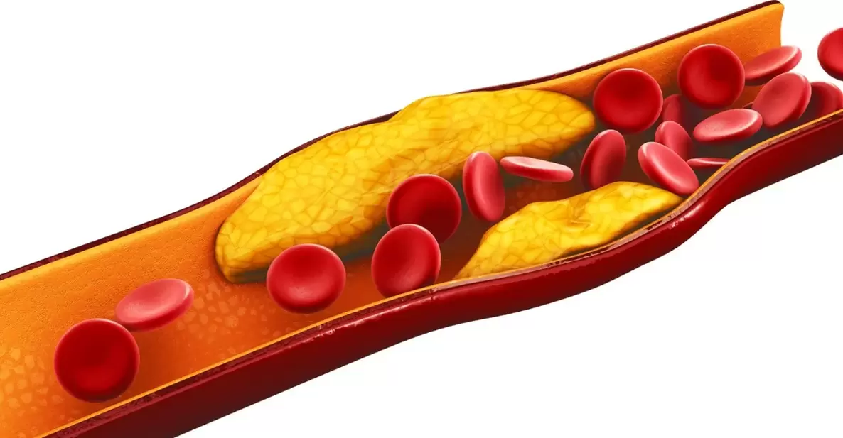 The reason for using MiCardium tablets is due to vascular atherosclerosis